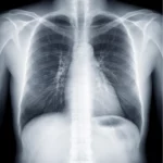 Radiografie toraco-pulmonară a plămânilor utilizată în diagnosticul afecțiunilor respiratorii