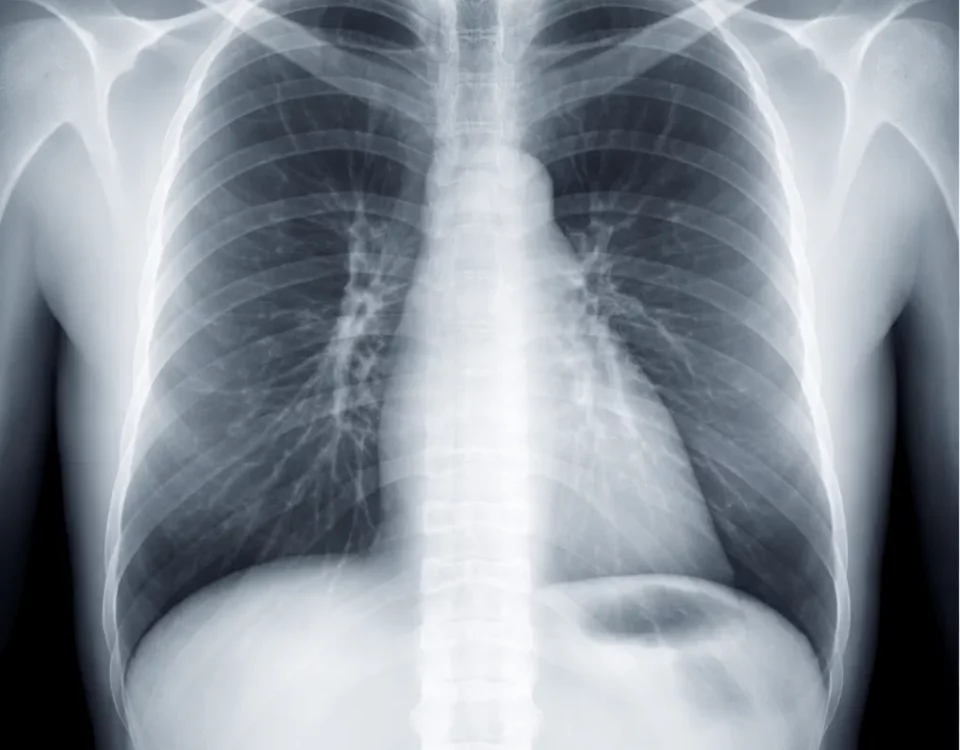 Radiografie toraco-pulmonară a plămânilor utilizată în diagnosticul afecțiunilor respiratorii