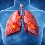 pneumonie – infecție pulmonară la nivelul plămânilor